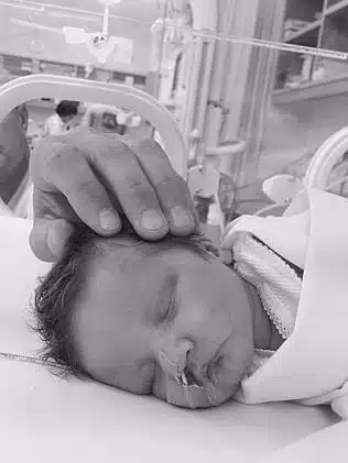 Baby Tate Burley suffers from a rare brain disorder