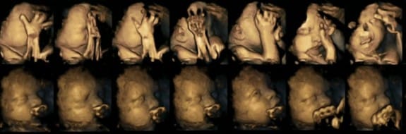 Top row: Fetuses of smoking mothers at 32 weeks; Bottom: Non-smoking mothers /via Nadja Reissland, Durham University