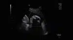 Jess Evans's ultrasound