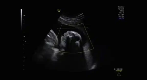 Jess Evans's ultrasound