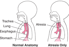 esophageal atresia