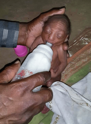 Baby in Indian village with IUGR