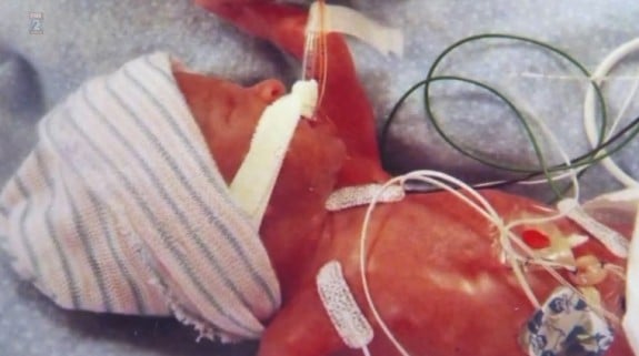 23 week preemie Trevor Frolek