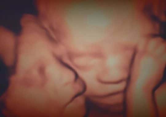 ultrasound photo of twins
