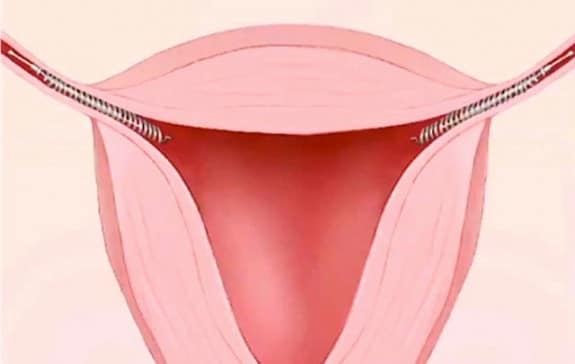 Essure Birth Control Implant