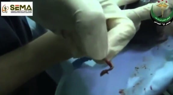 Unborn Syrian baby mother injured by shrapnel saved by doctors