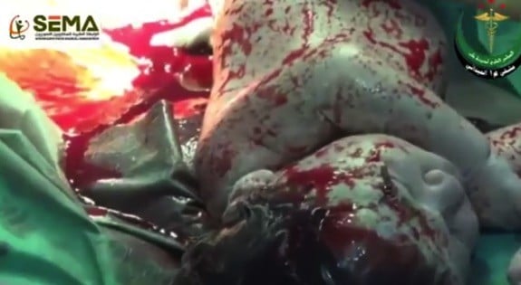 Unborn Syrian baby, mother injured by shrapnel saved by doctors