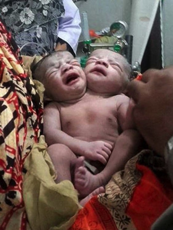 Bangladesh baby girl born with two heads