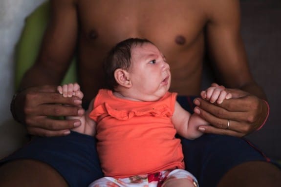 Baby delivered with Zika Virus