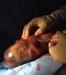 baby being released from her amniotic sac - en caul birth