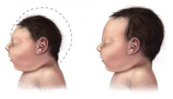 Microcephaly brain comparison