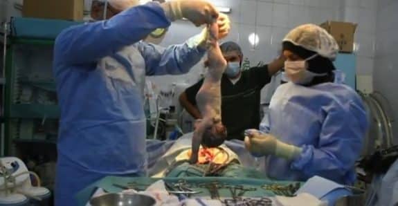 doctors revive baby born in a Syria bombing