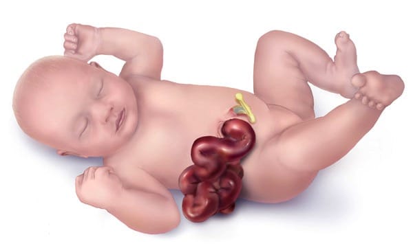 gastroschisis