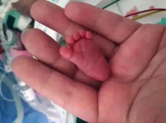 worlds-tiniest-baby-emilia