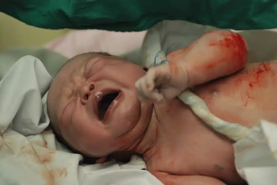 newborn infant in the operation room