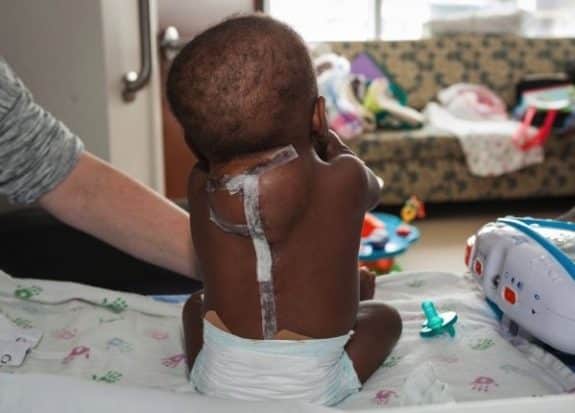 baby Dominique after surgery to remove parasitic twin