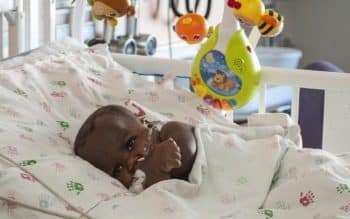 baby Dominique undergoes surgery to remove parasitic twin