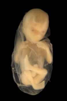 symptoms of low amniotic fluid