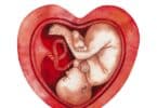 What Is A Placental Abruption