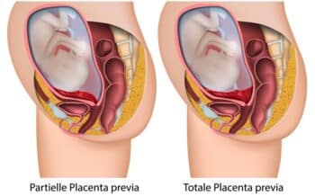 What is Placenta Previa?