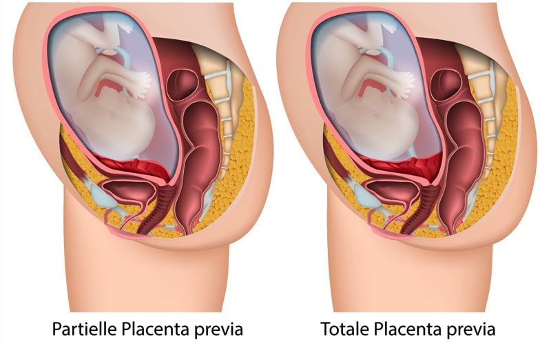 What is Placenta Previa?