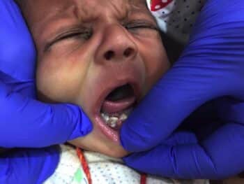baby born with seven teeth