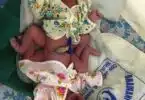 mother gave birth to conjoined twins naturally