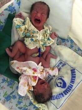 mother gave birth to conjoined twins naturally