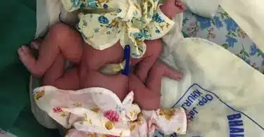 mother gave birth to conjoined twins naturally