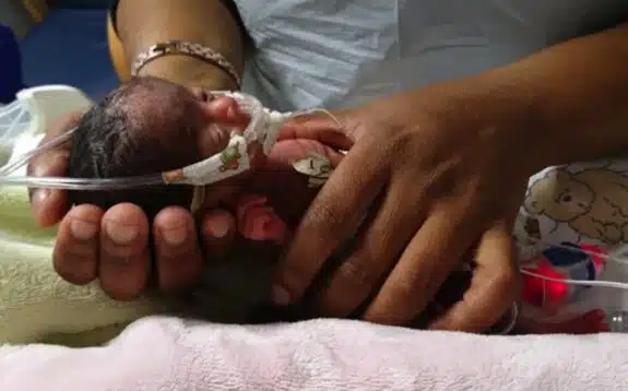 395gram micro-preemie Jazeel