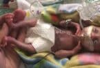 Baby born at 21 weeks, four days gestation