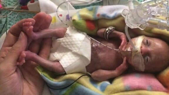 Baby born at 21 weeks, four days gestation