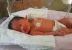 Eiko Crisostomo Canada's first in-utero spina bifida baby