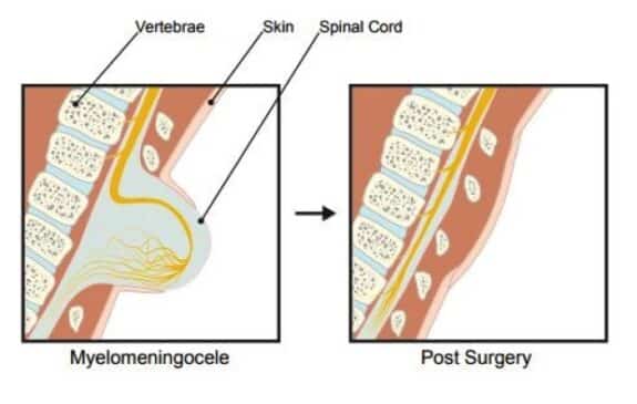 illustration of spina bifida in-utero