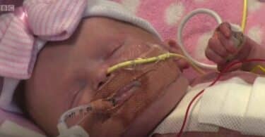 Baby Vanellope born with ectopia cordis at Glenfield Hospital in Leicester