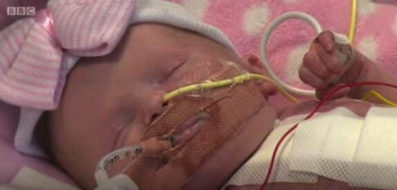 Baby Vanellope born with ectopia cordis at Glenfield Hospital in Leicester