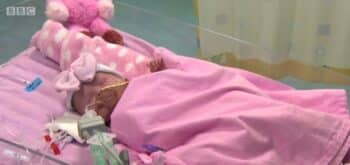 Baby Vanellope born with ectopia cordis at Glenfield Hospital in Leicester