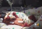 Tiny preemie Cayden