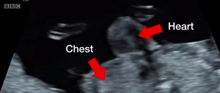 Ultrasound Scan Of Ectopia Cordis Growing Your Baby