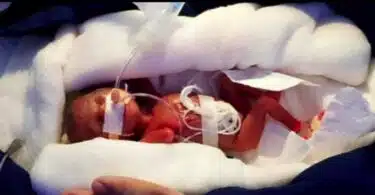 14oz Baby Smallest To Survive In Asia