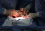 Second U.S. Baby Born VIA Transplanted Uterus