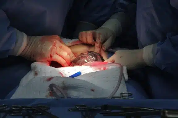 Second U.S. Baby Born VIA Transplanted Uterus