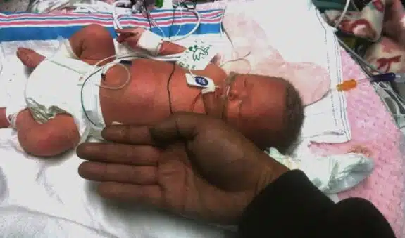 Toddler Grace Rosian survives cancer twice