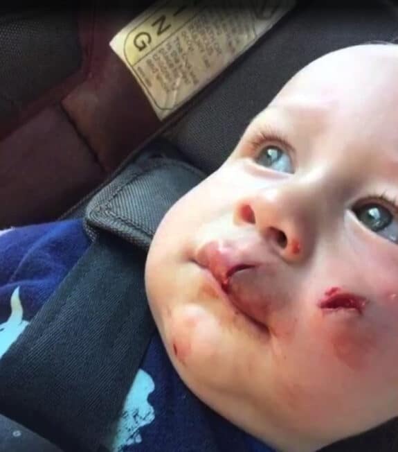 Rogue Drone Slashes Toddler's Face
