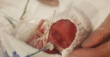 Sussie Bea Patrick newborn 22 week baby
