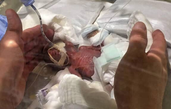 A baby born weighing 268 grams 