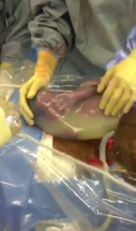 INCREDIBLE En-Caul Birth Captured On Camera!