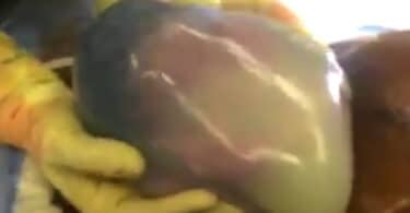 Incredible Gentle C-Section En-Caul Birth Captured On Camera f