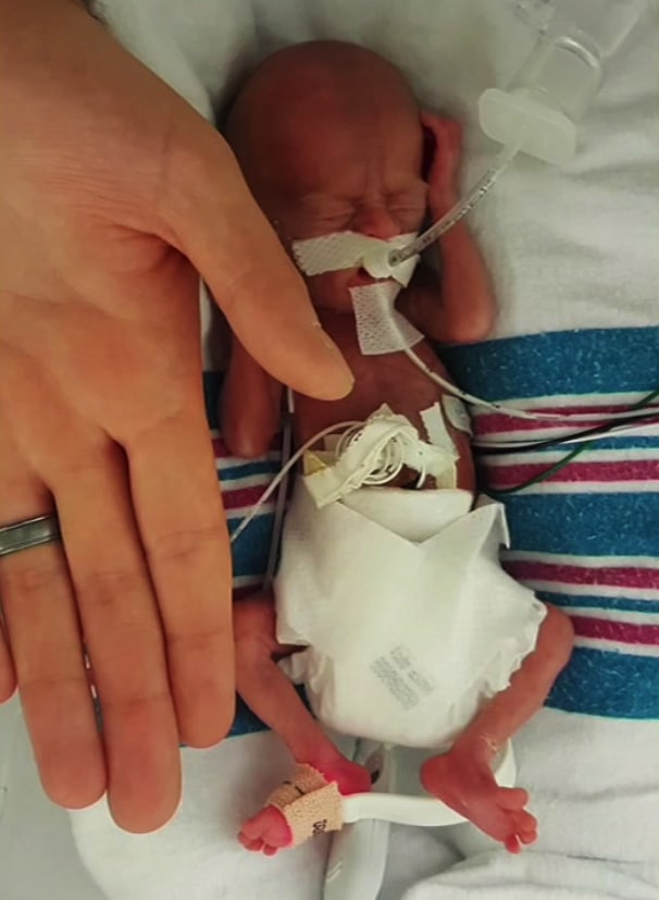 Tiny 11 Ounce Baby Joins Family At Home!