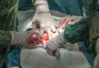 baby being born c section